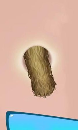 挤痘痘达人免费版